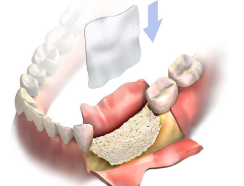 Cos’è la rigenerazione ossea dentale?
