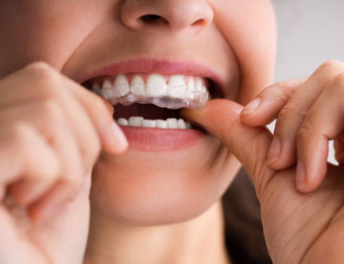 Bruxismo: come smettere di digrignare i denti