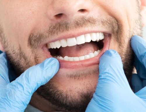 Cosa evitare di mangiare per avere i denti bianchi