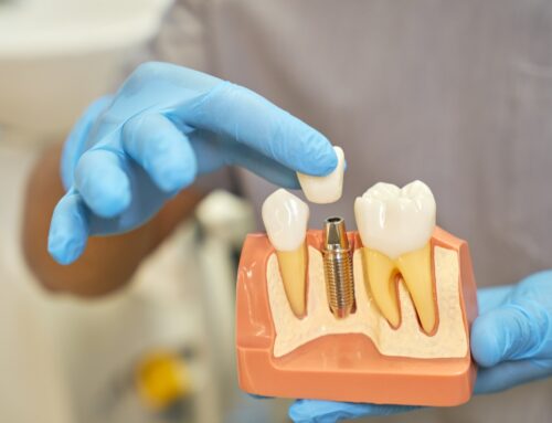 Impianto dentale senza bucare l’osso: è possibile?